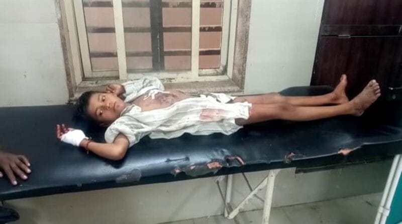 11-year-old boy injured due to explosion of mobile battery in Damoh, admitted to hospital, mobile battery explosion, accident, damoh news