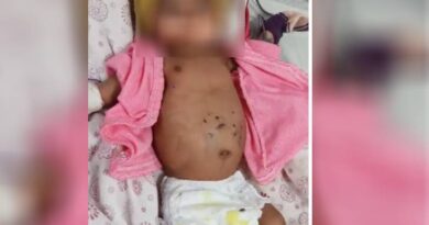 The innocent child was burnt 51 times with incense sticks, was suffering from pneumonia; condition serious, shahdol, MP news, today updates, kalluram news, crime