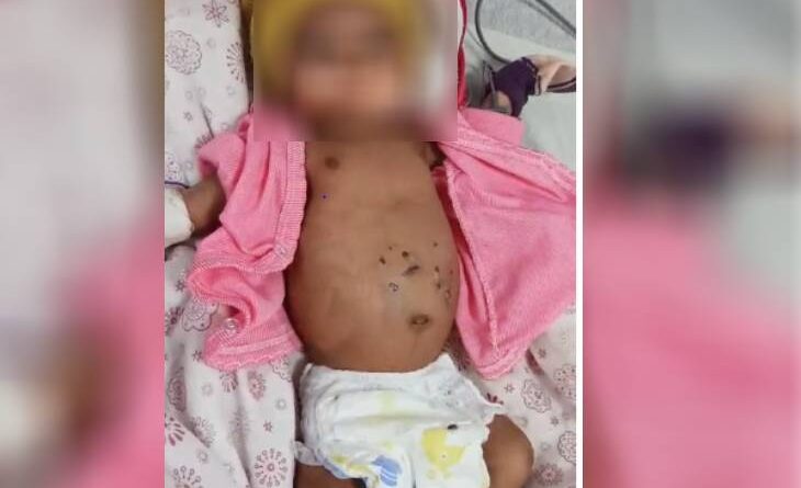 The innocent child was burnt 51 times with incense sticks, was suffering from pneumonia; condition serious, shahdol, MP news, today updates, kalluram news, crime