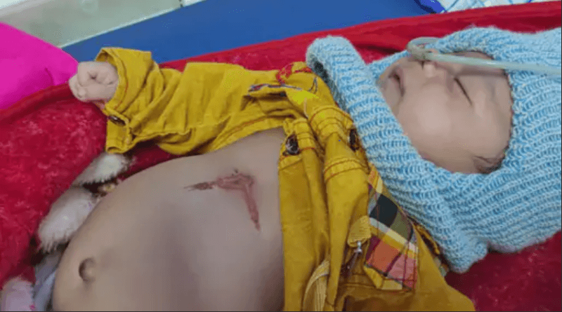 In Ujjain, a one and a half month old baby was branded with a hot rod, used a trick to cure pneumonia; admitted to hospital, ujjain, kalluram news, crime, child admit in hospital