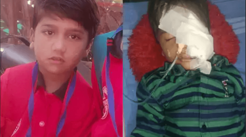 In Bhopal, a dog scratched the jaw of a 6 year old child and also ate his teeth; got 20 stitches, Kalluram News, Today Updates, Bhopal, Dog Bite, Nagar Nigam Bhopal