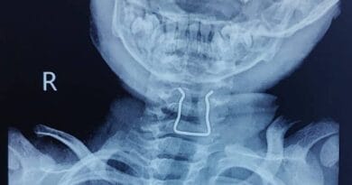 जबलपुर में दो साल के मासूम ने निगली पिन, गले में फंसी; डॉक्टरों ने 30 मिनट ऑपरेशन कर निकाली  2 In Jabalpur, a two year old innocent boy swallowed a pin, it got stuck in his throat; Doctors operated in 30 minutes, Jabalpur, Kalluram News, Today Updates