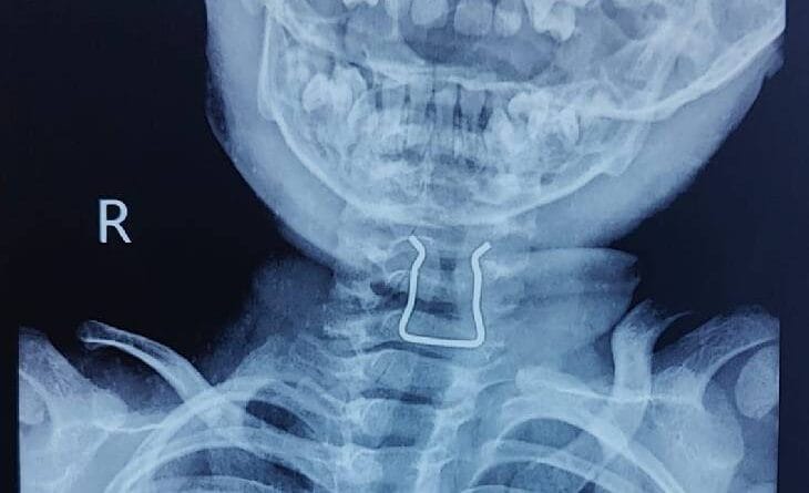 In Jabalpur, a two year old innocent boy swallowed a pin, it got stuck in his throat; Doctors operated in 30 minutes, Jabalpur, Kalluram News, Today Updates