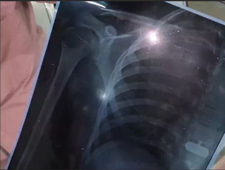 टीचर ने 7वीं के छात्र का हाथ मरोड़ा, कंधे की हड्डी टूटी; स्टूडेंट के दूसरे विषय की कॉपी निकालने से नाराज था 2 A teacher twisted a 7th-grade student's arm In Chhatarpur